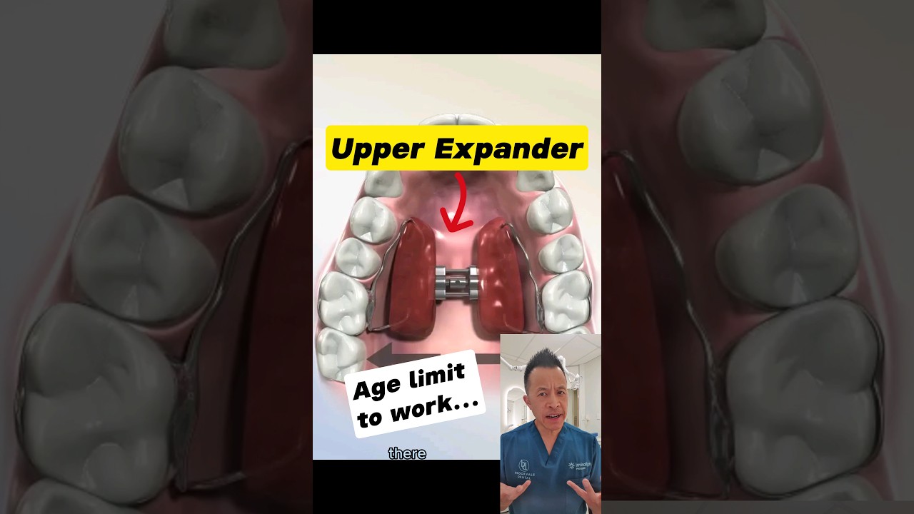 Best Age for Upper Expander: Ideal Age Revealed! #dentallan #dentist #shorts