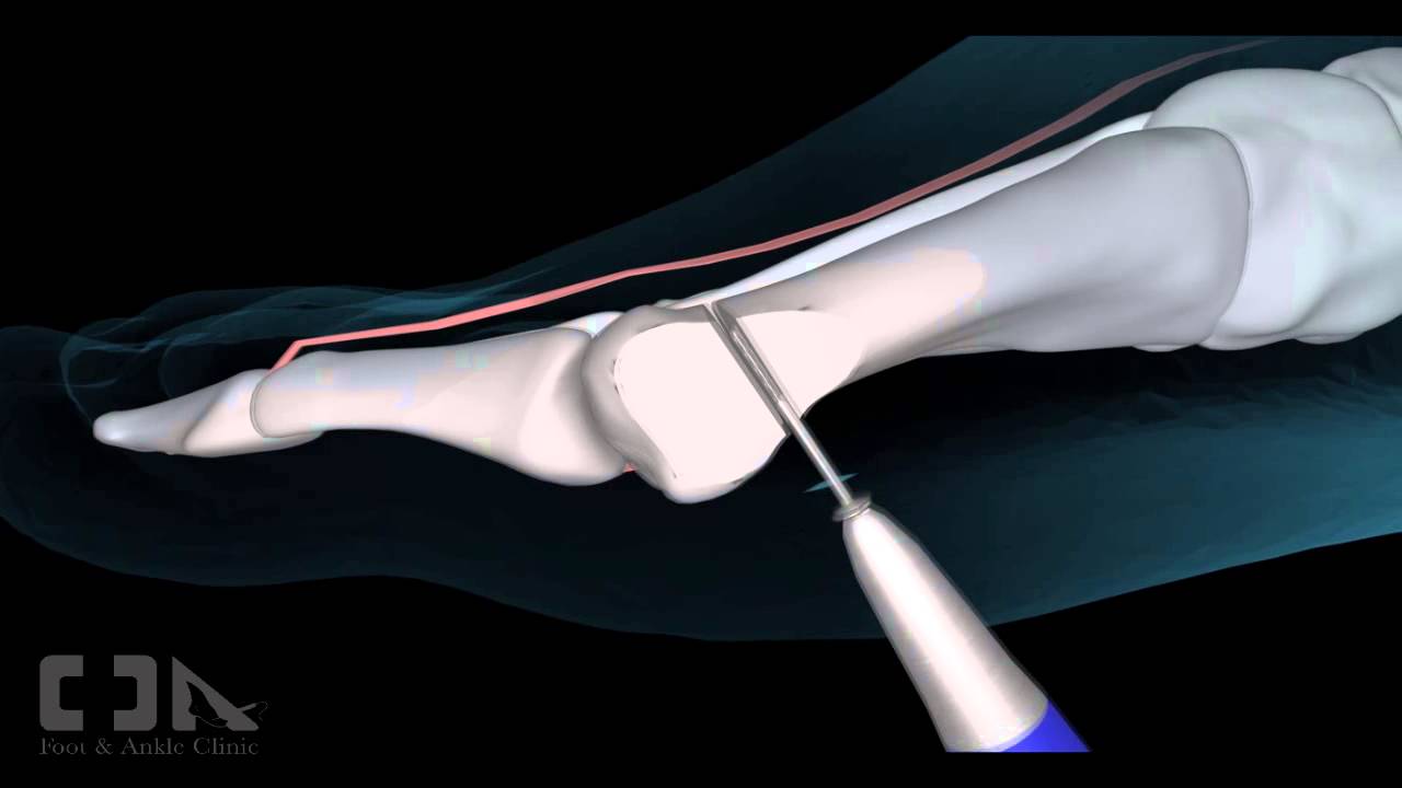 Minimally Invasive Bunion/Hallux Valgus Surgery