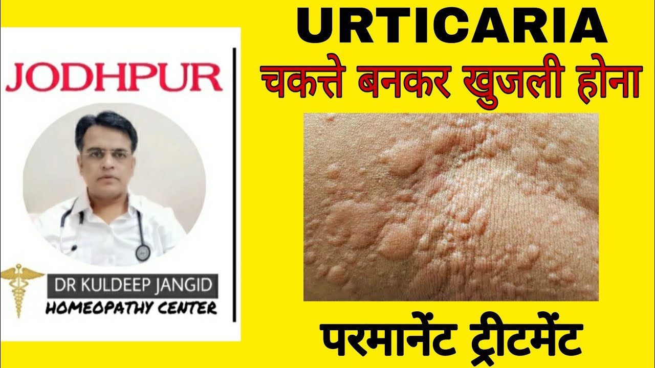 गोल चकत्ते बनकर खुजली परमानेंट ट्रीटमेंट । Urticaria permanent treatment in homeopathy । Hives ।
