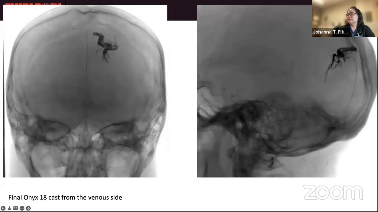 Embolization of AVMs for Cure with Johanna T. Fifi, MD
