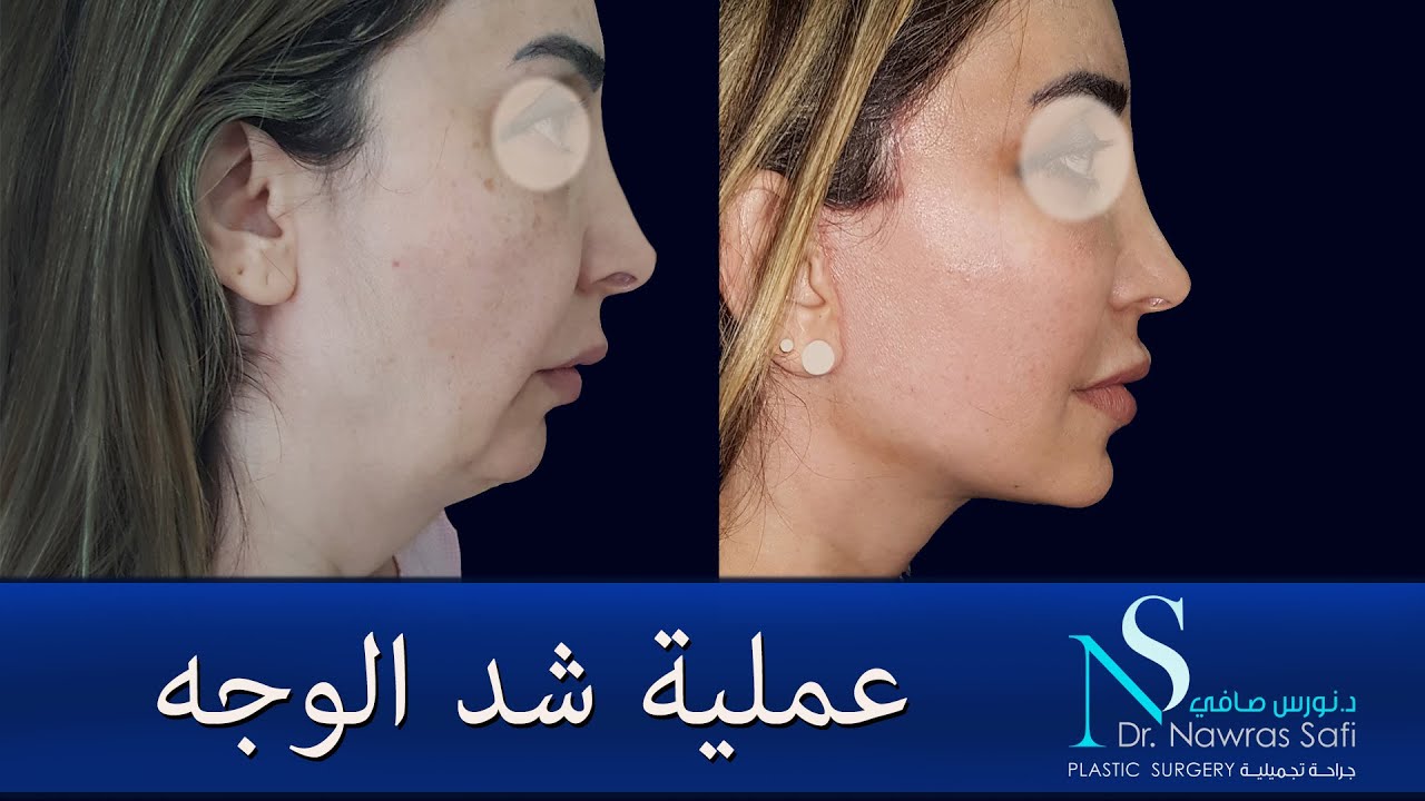 معالجة تجاعيد الوجه بالجراحة عملية شد الوجه الدكتور نورس صافي دمشق سوريا سورية معلومات ضرورية جداً
