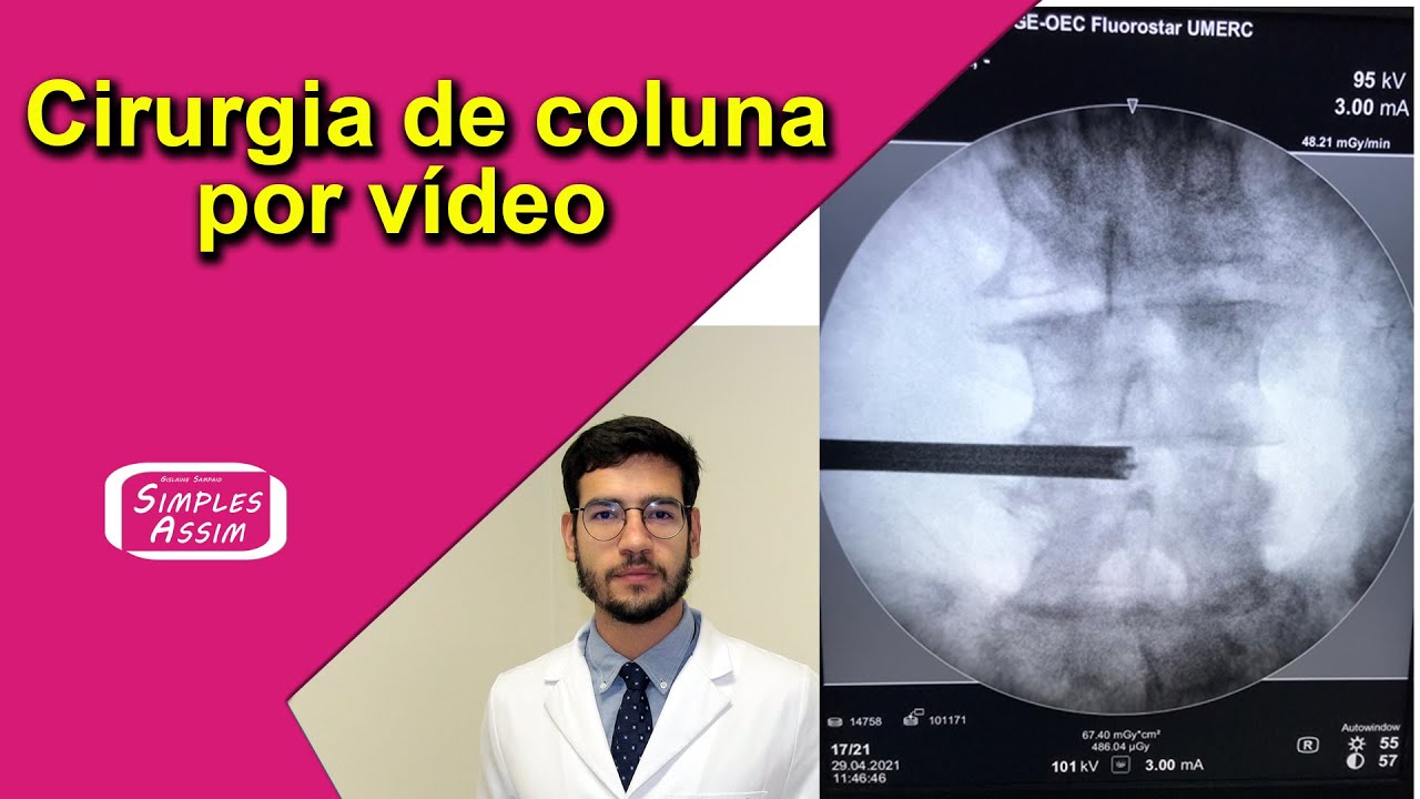 Cirurgia na coluna por endoscopia