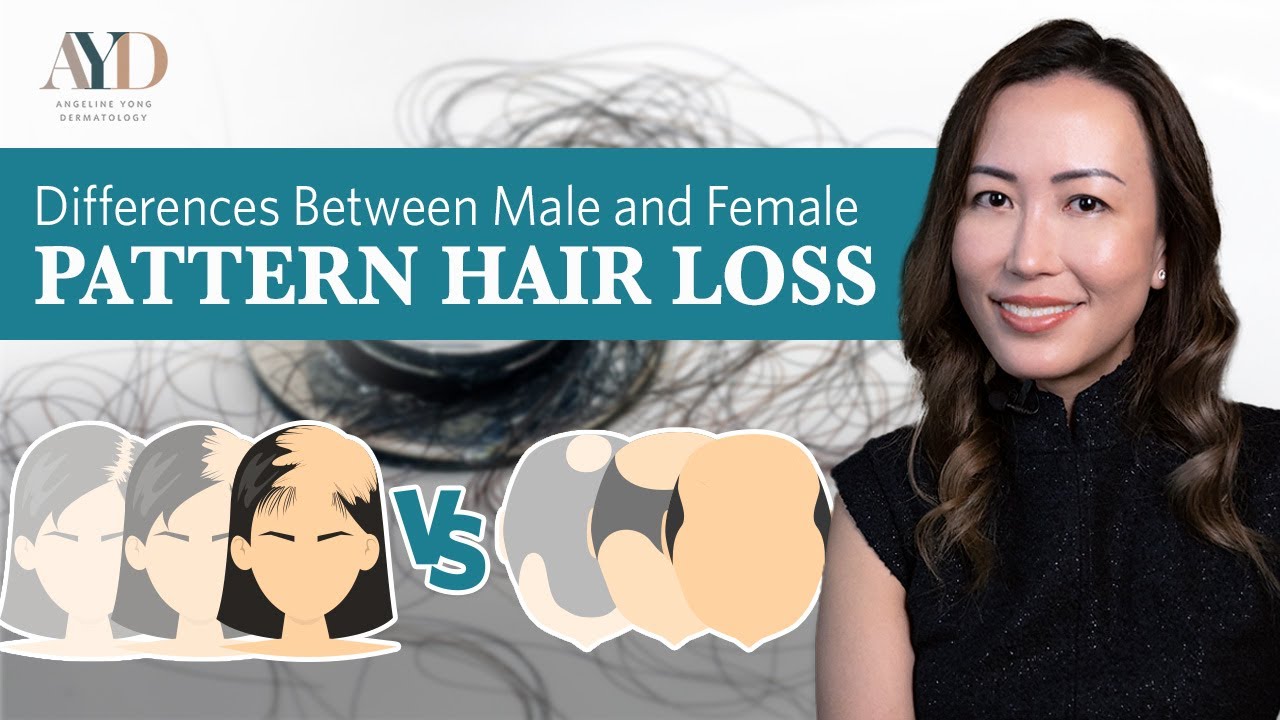 Differences Between Male and Female Pattern Hair Loss