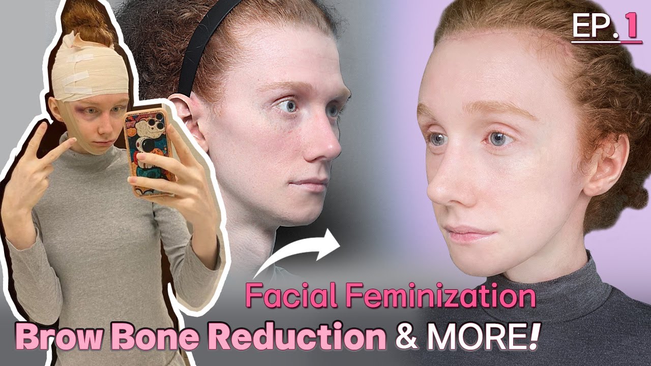 [SUB] Remarkable Result of Facial Feminization Surgery in Korea! | Browbone Reduction Before& After