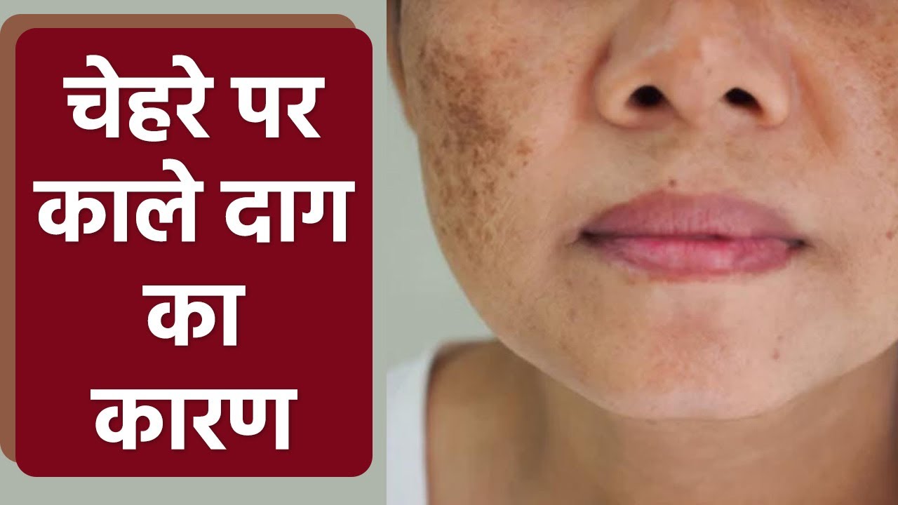 चेहरे पर काले दाग क्यों होते है । चेहरे पर काले दाग होने का कारण । Boldsky *Health