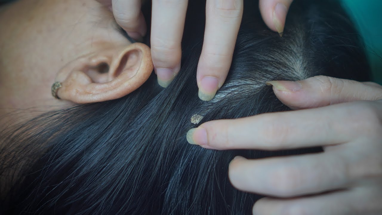 ASMR Scalp Scratching For Deep Relaxation | Intense Hair Sounds, Close-Up Triggers