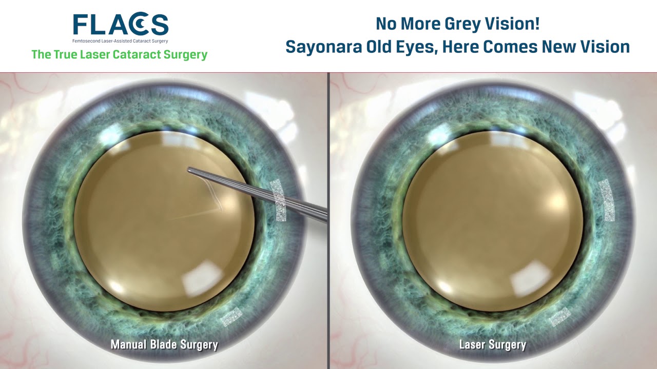 FLACS (Femtosecond Laser Assisted Cataract Surgery)