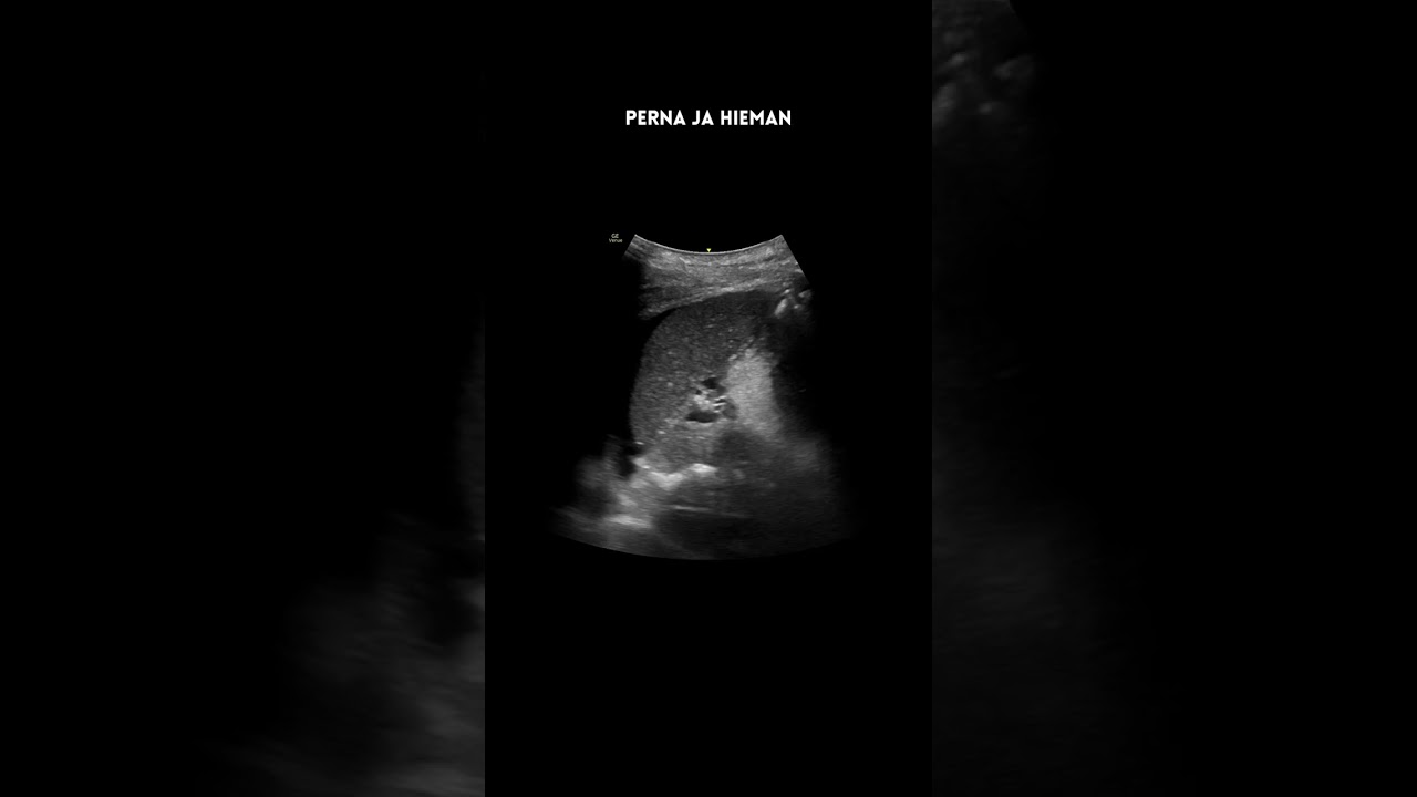 eFAST on traumapotilaan ensiarvion ultra&auml;&auml;nitutkimus