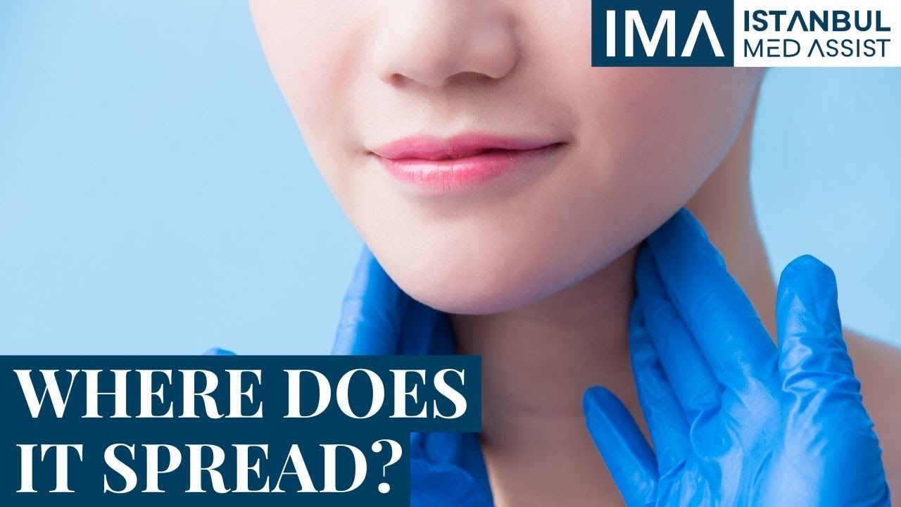 Where Does Salivary Gland Cancer Spread to? - Otolaryngology