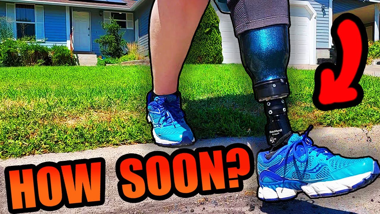 How Soon Will I Get a Prosthetic Leg After Amputation?