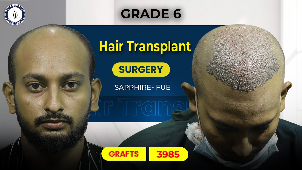 Amazing Hair Transplant Surgery Experience (3985 Grafts) | Hairfree and Hairgrow | #bangladesh