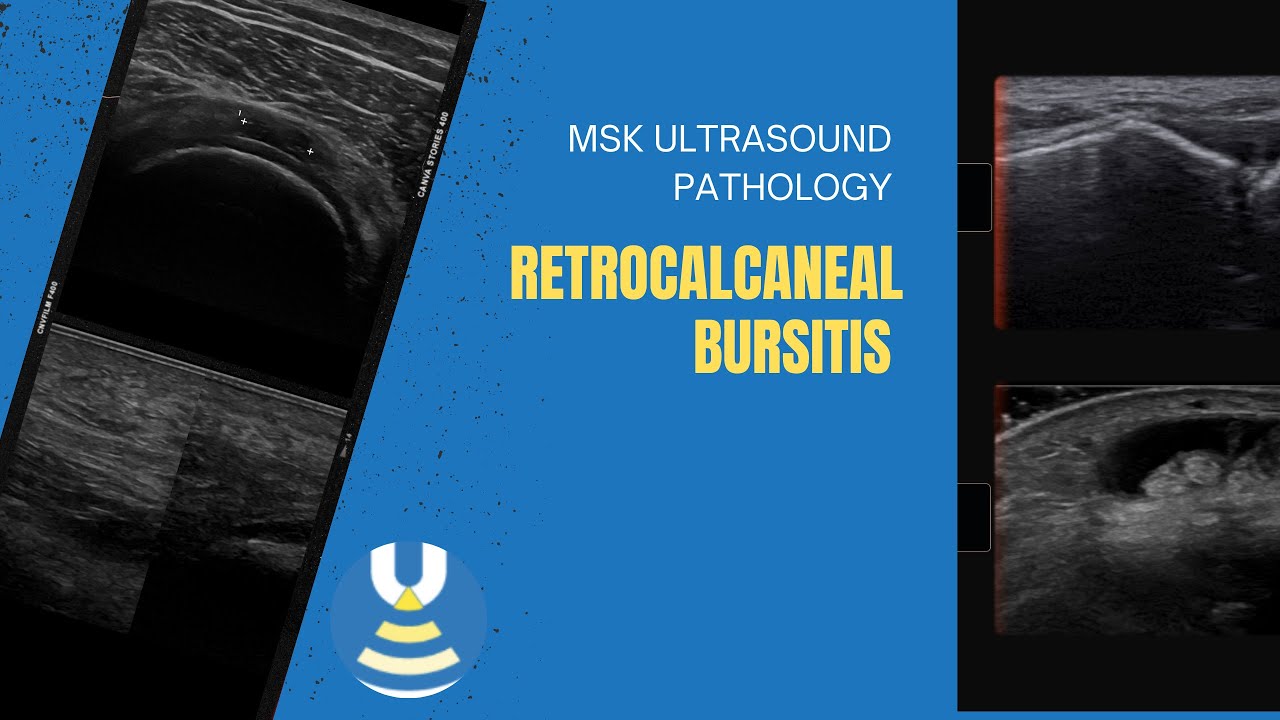 Ultrasound appearance of retrocalcaneal bursitis