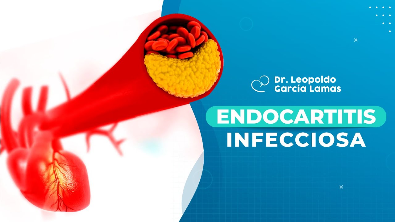 Endocarditis Infecciosa | Dr Leopoldo García Lamas