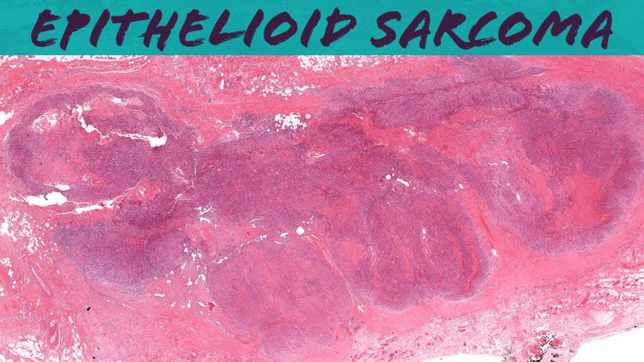 Epithelioid Sarcoma (don't confuse with rheumatoid nodule or granuloma annulare!) (Oregon Case 10)