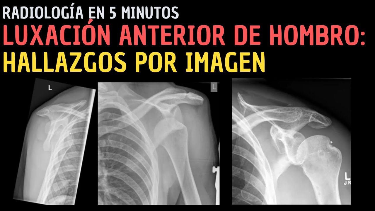 Radiología en 5 minutos: Luxación anterior de hombro: hallazgos por imagen y lesiones asociadas.