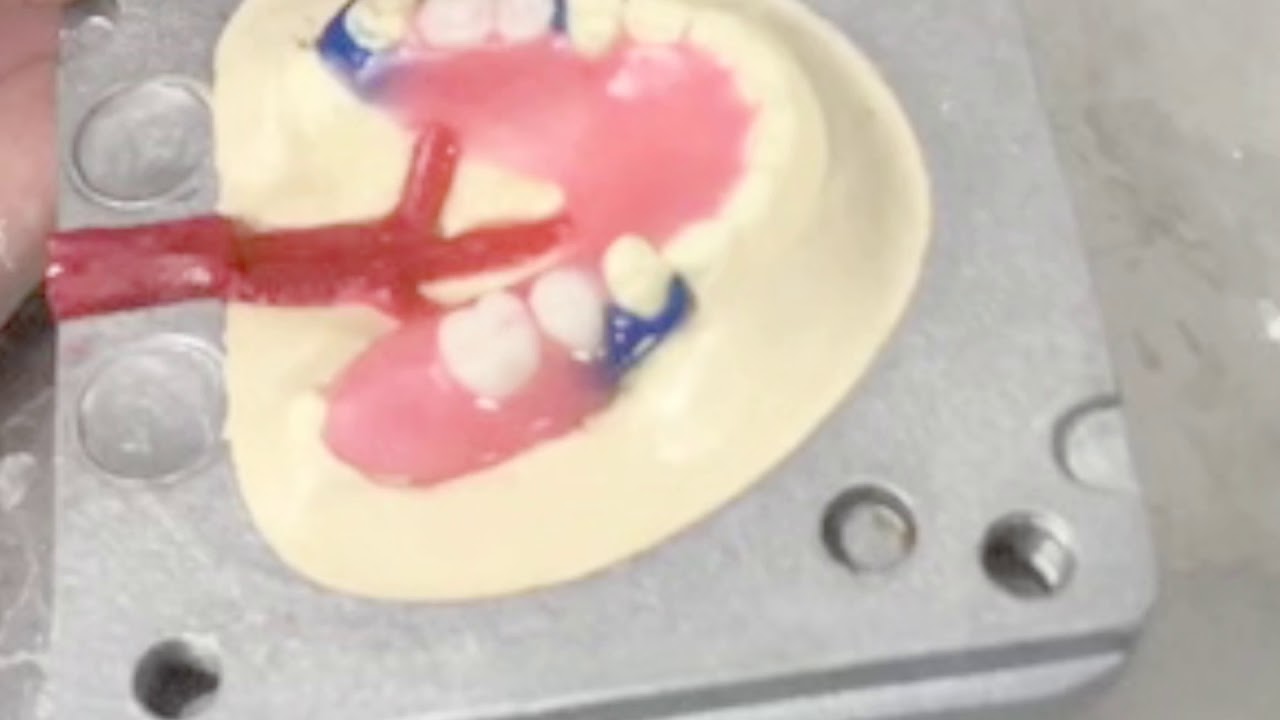 DuraFlex Partials, Start to Finish in Only 3 Minutes?