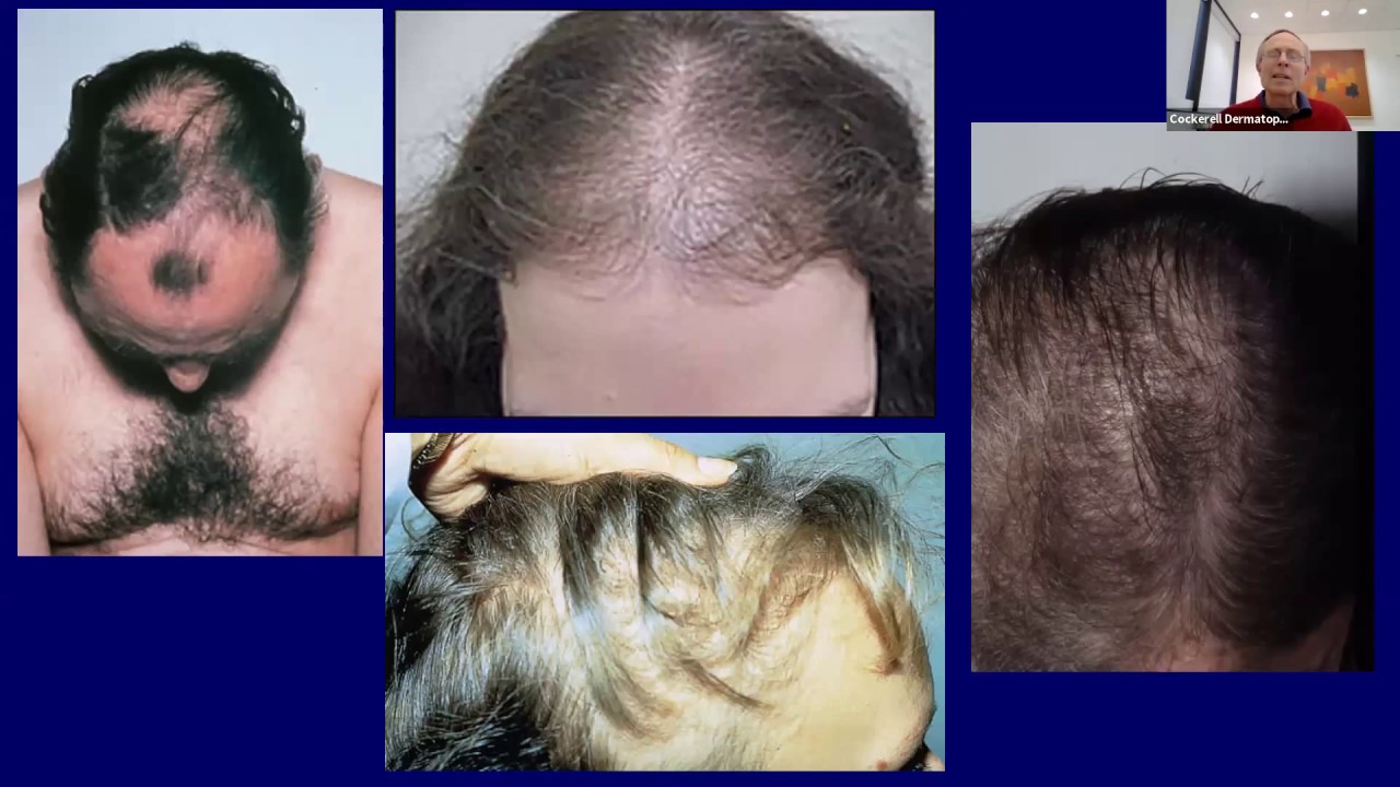 Alopecia Diagnosis Made Easy