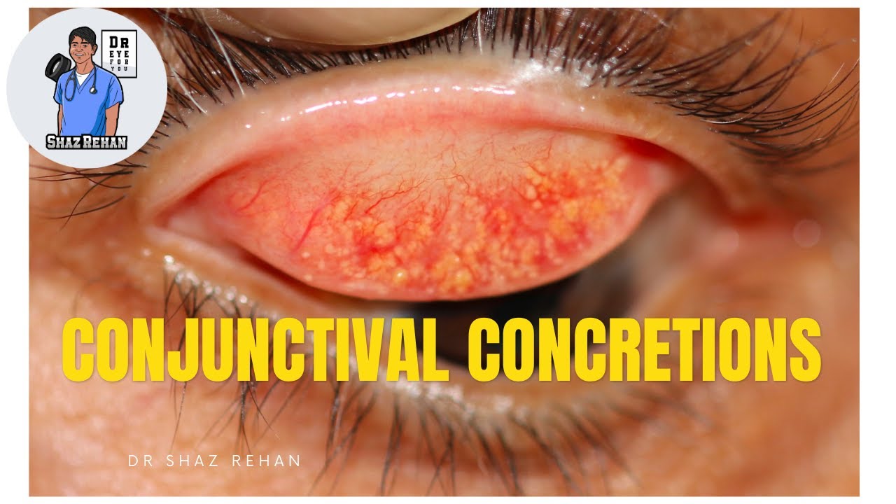 Conjunctival Concretions. What are they? Eye Dr Explains.