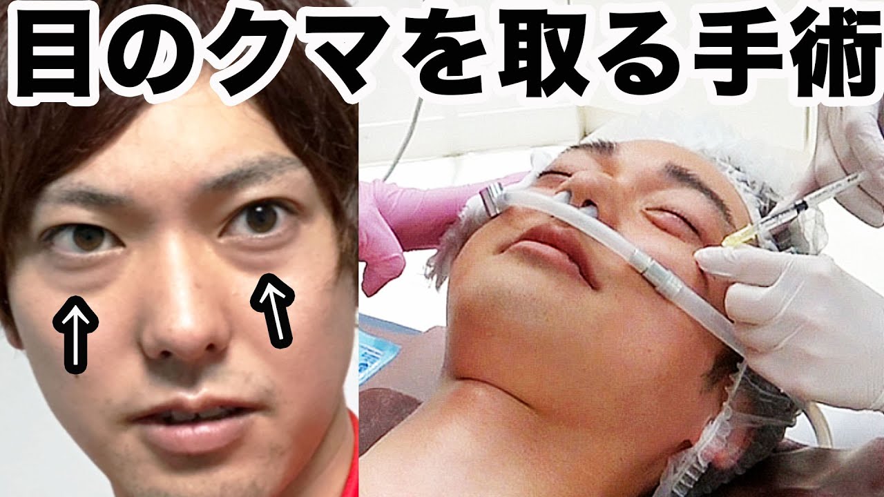 消えない「目のクマ」を取る手術を受けてみた結果。。