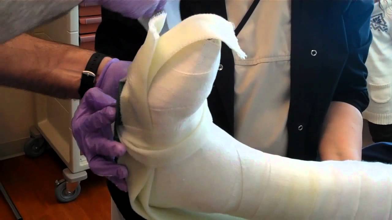 Ulcer Debridement with Total Contact Cast Part 2