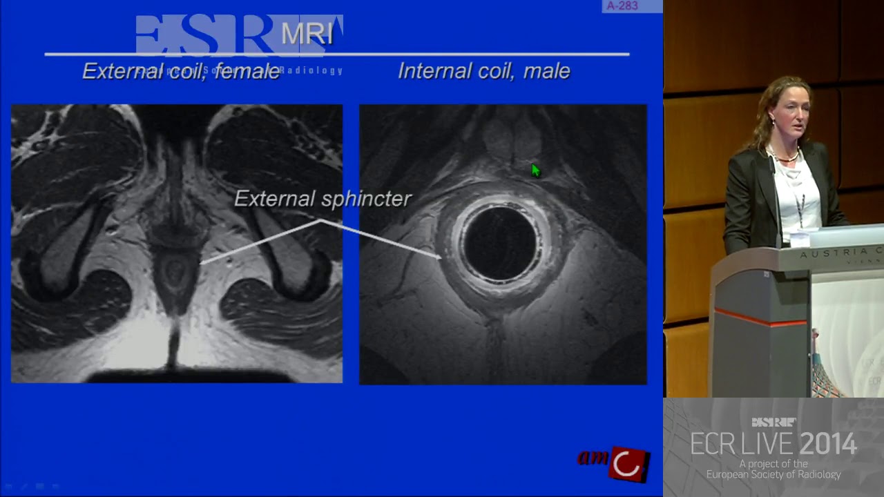 GI - Perianal fistula disease - All you need to know 1