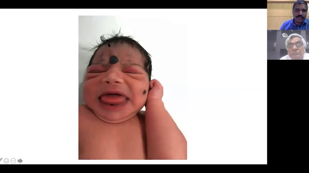 Neonatal Hypoglycemia