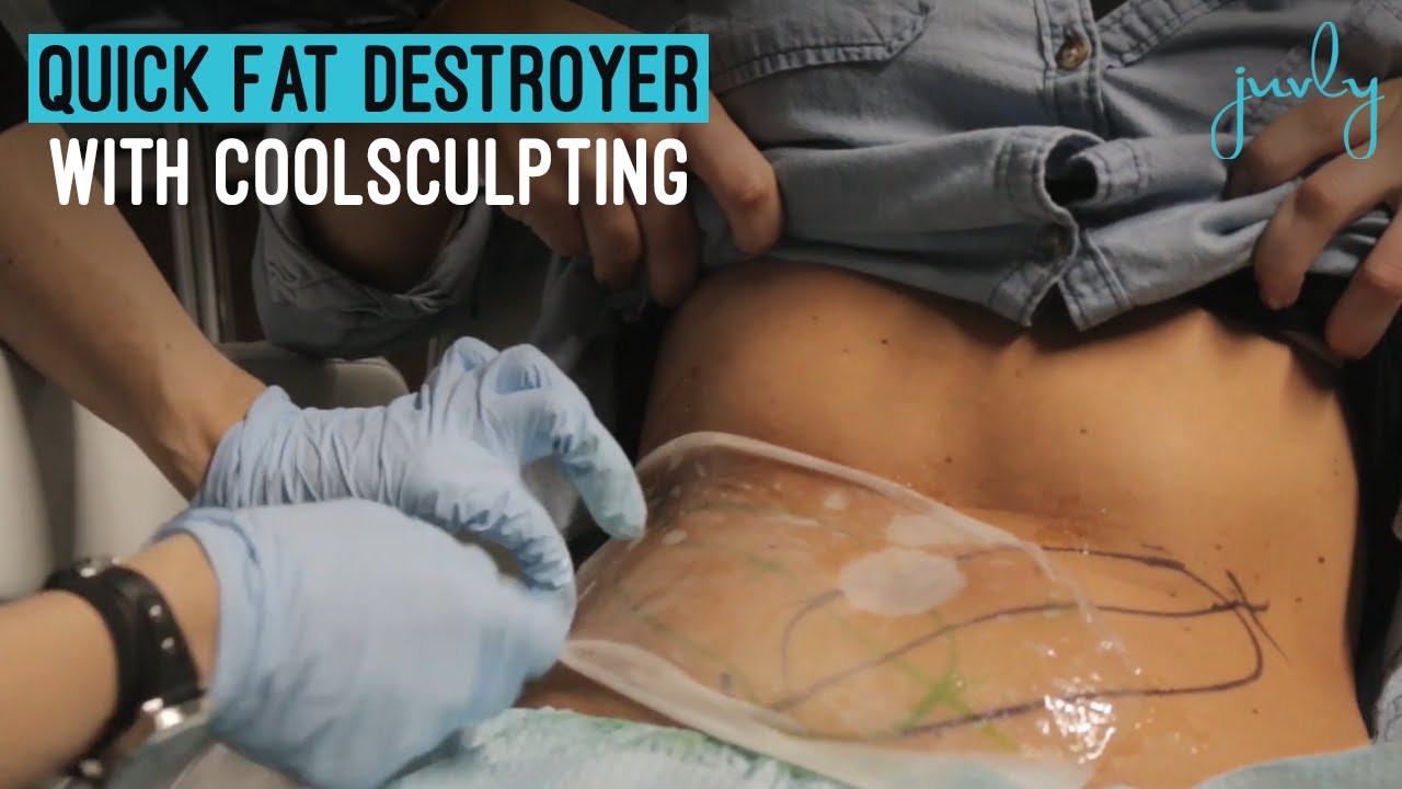Quick Fat Destroyer with CoolSculpting Treatment| Explore the Visible Results at Juvly