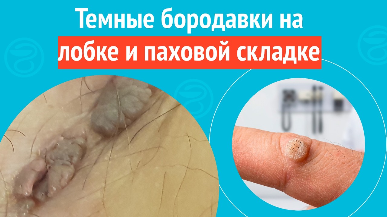 🥺 Темные бородавки на лобке и паховой складке. Клинический случай № 1734