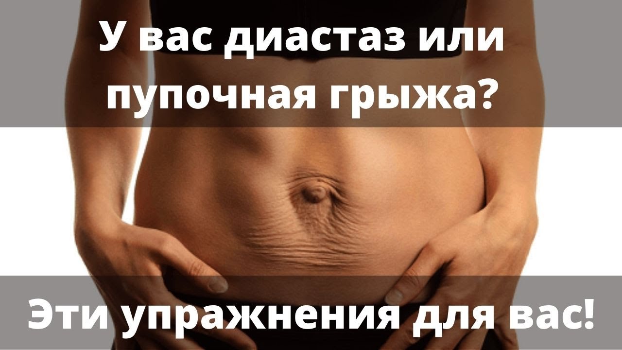 Упражнения при диастазе и пупочной грыже