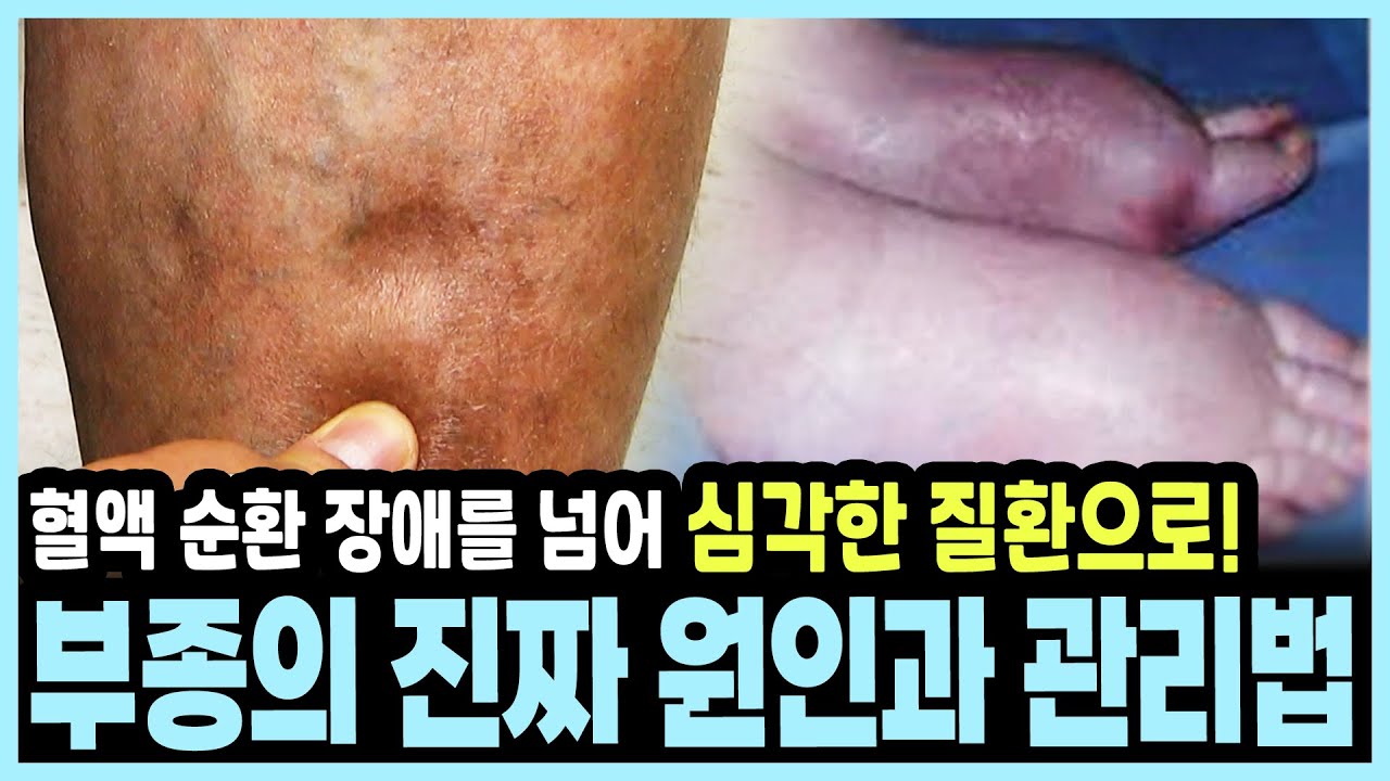 생명을 위협하는 붓기! 손발, 팔다리 부종이 보내는 심장 질환과 심부정맥혈전증의 위험 신호를 놓치지 마세요! I KBS 20180304 방송