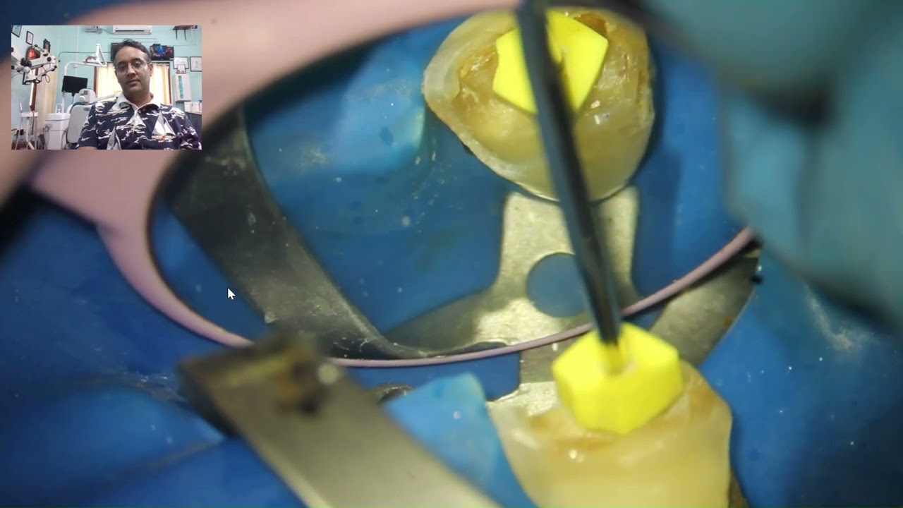Non-Vital Central Incisor Treated with MTA Apical Plug &ndash; Step-by-Step Endodontics