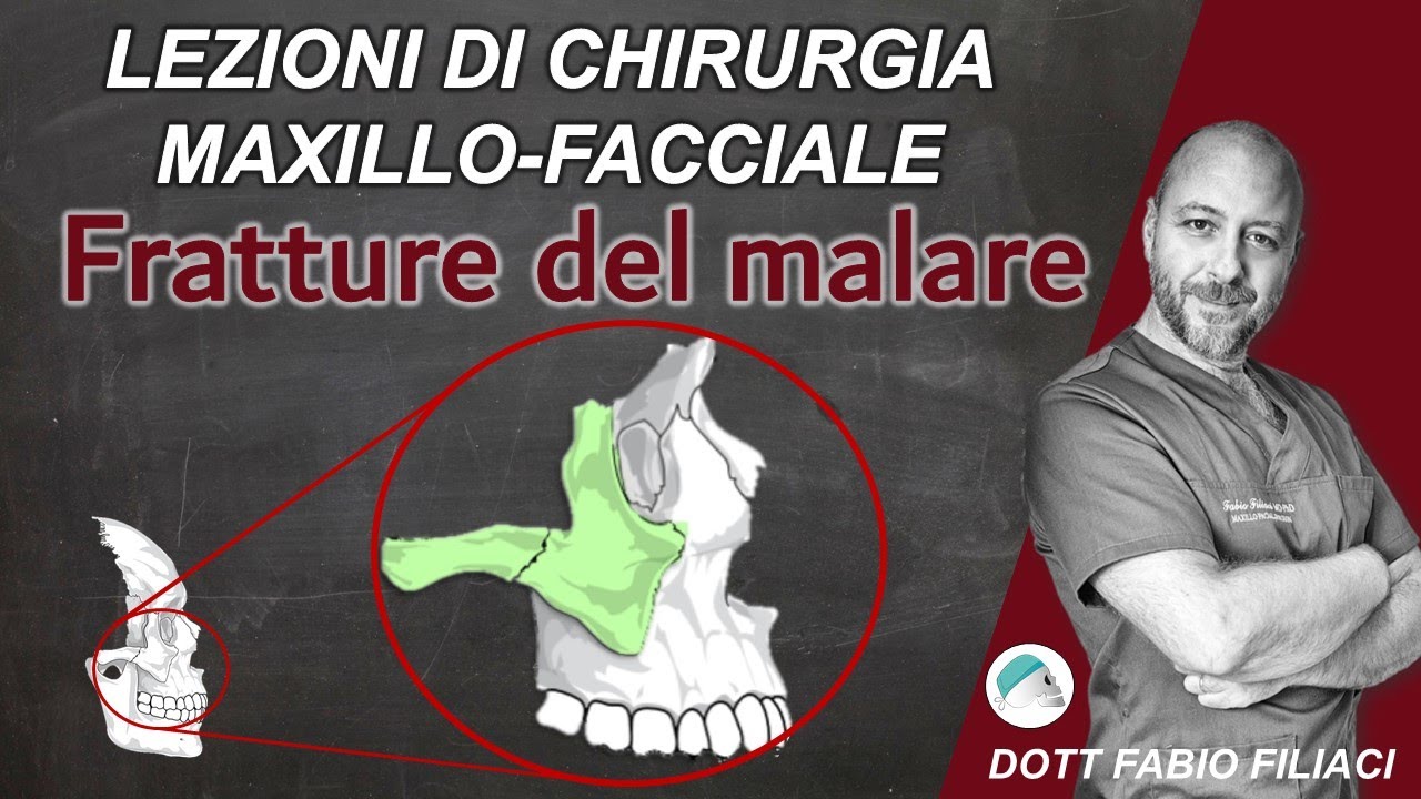 Lezione di Chirurgia Maxillo Facciale: le fratture dello zigomo