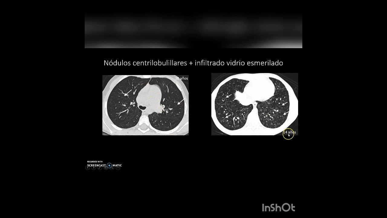 Hipertensión Pulmonar