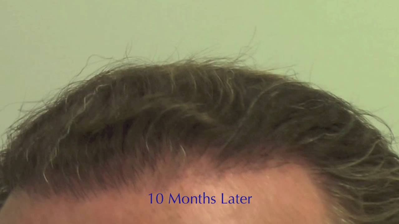 High-Definition Hairline Advancement - Carlos K. Wesley, M.D. (NYC)