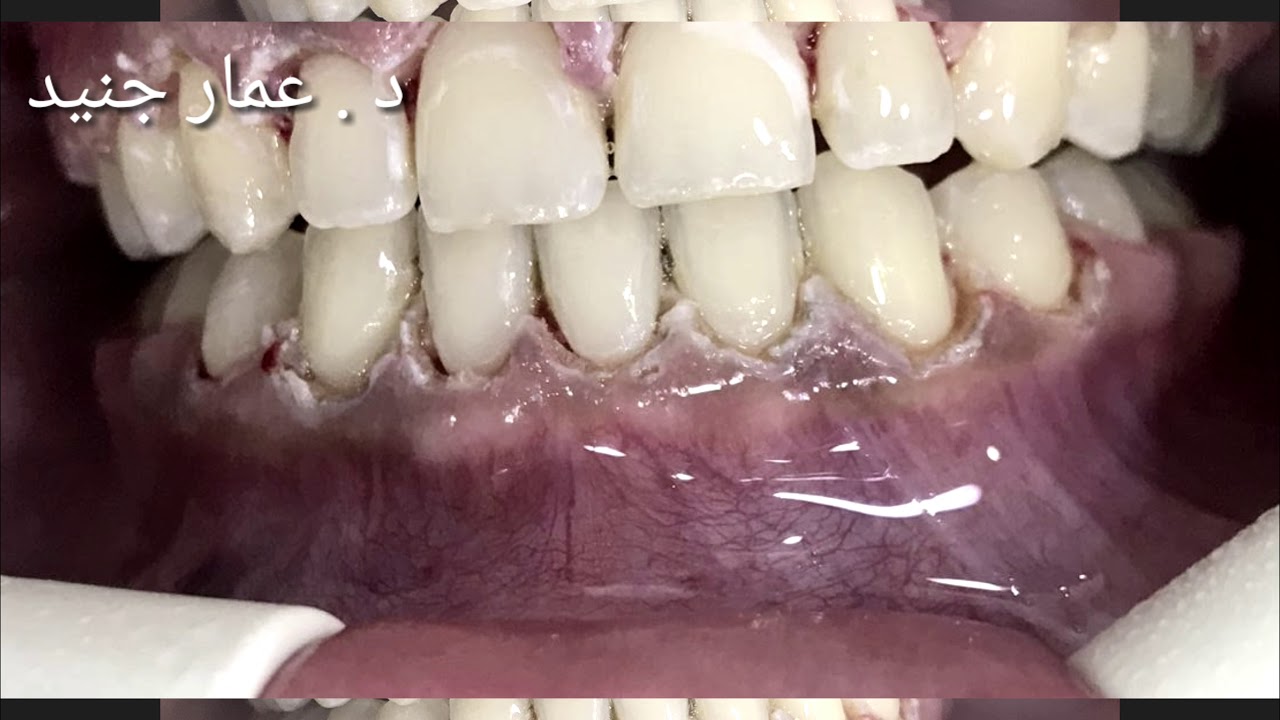 ابتسامة أجمل بعد قص اللثة .