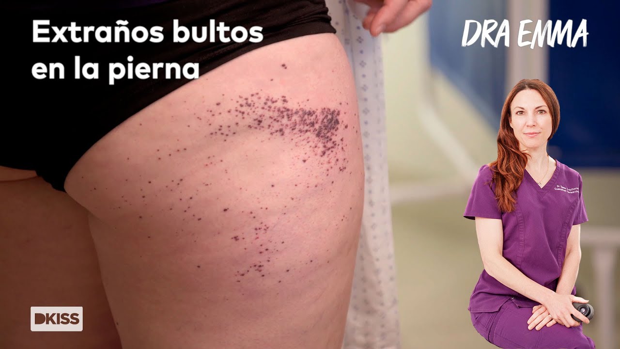 Extrañas manchas en la pierna | Dra Emma: Clínica dermatológica