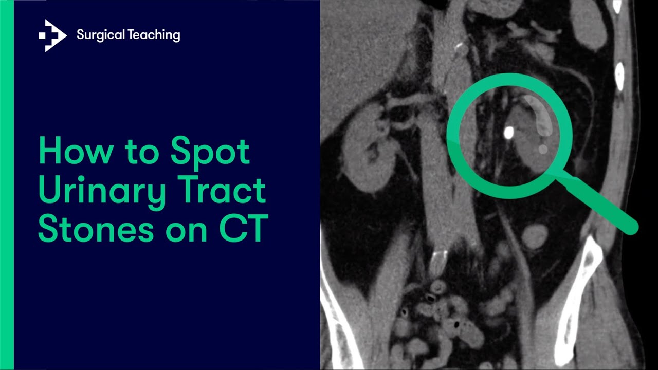 Камни в мочевыводящих путях | Как их диагностировать с помощью КТ?