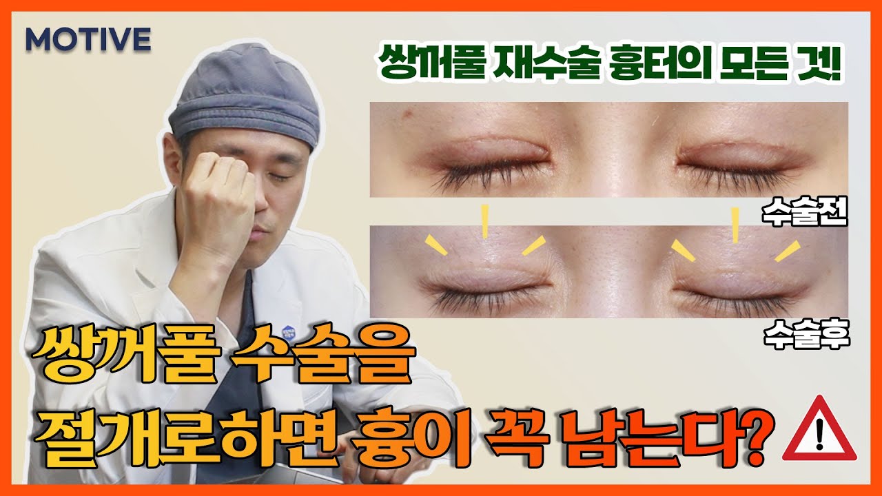 절개로 하면 피할수 없는 눈성형 흉터의 모든 것 ! # 쌍꺼풀흉터재수술