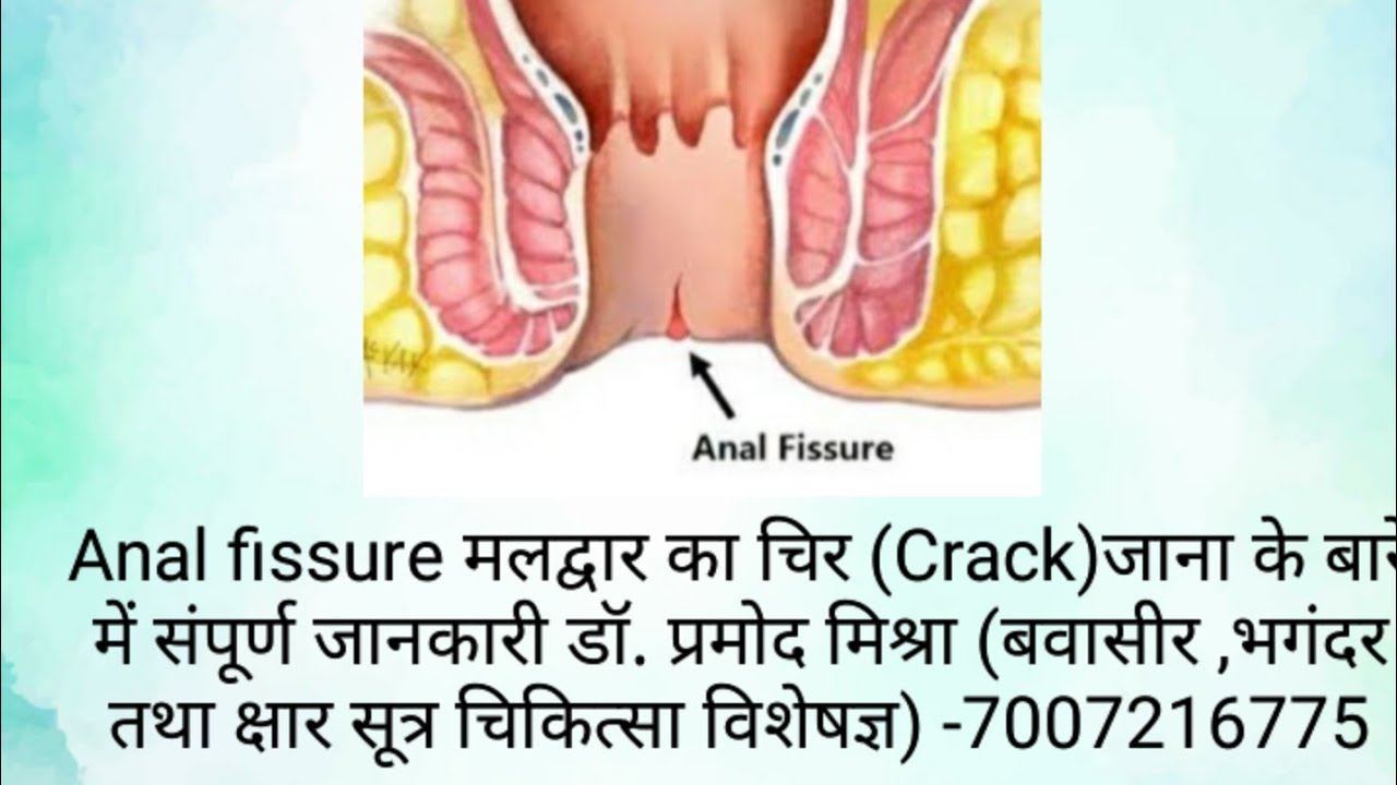 एनल फिशर( मलद्वार का चिर जाना) के बारे में जानकारी