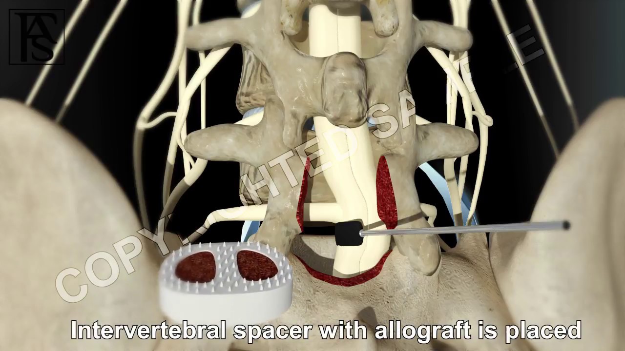 Lumbar Fusion of L5 S1 Posterior