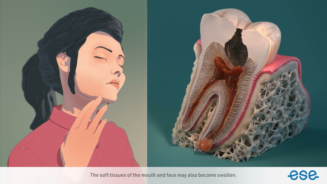 Antibiotics in Endodontics