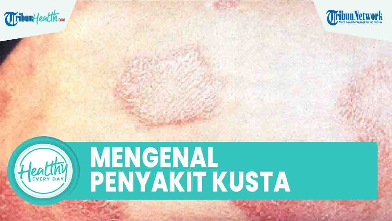 Mengenal Penyakit Kusta yang Dapat Rusak Saraf, Ini Gejala & Penyebab yang Diwaspadai Sejak Dini