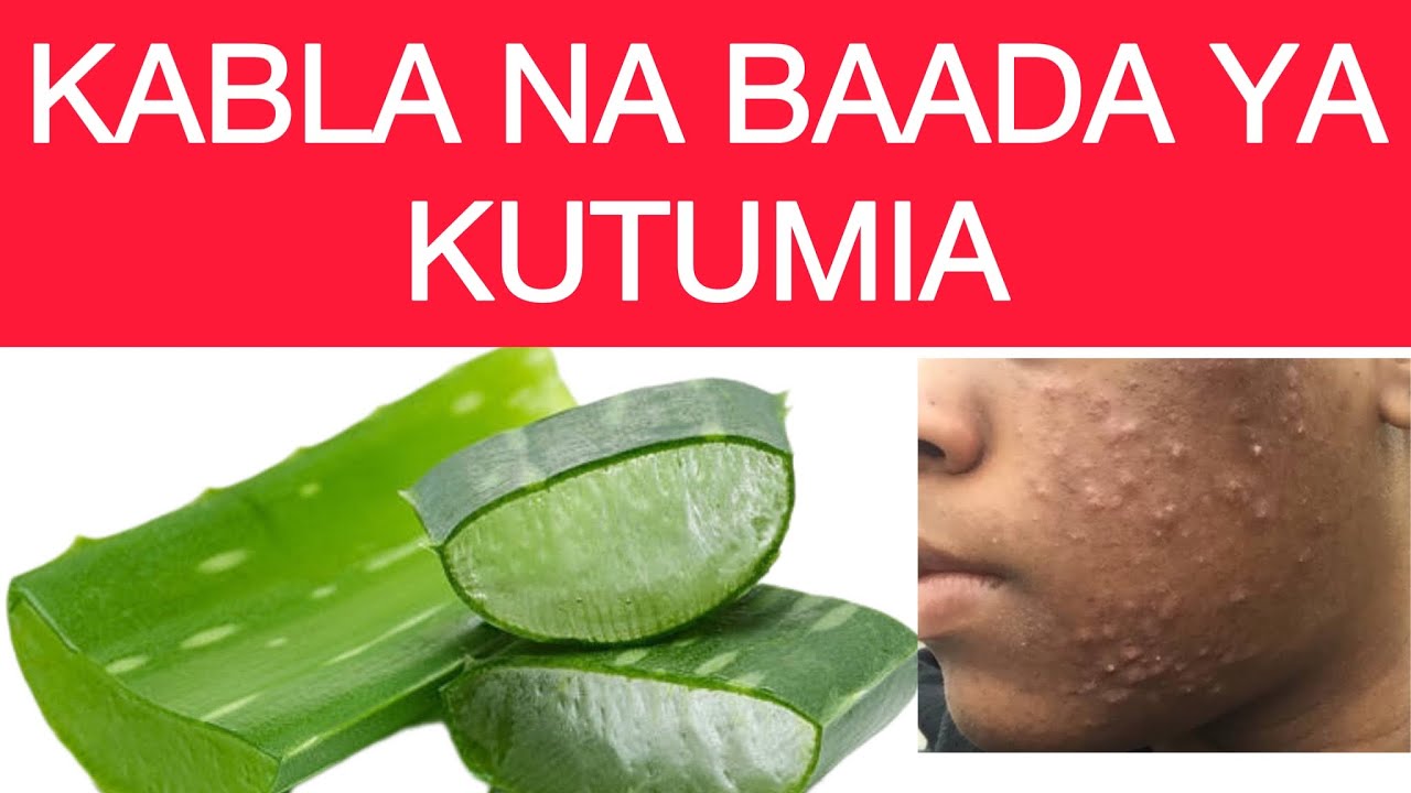 Kutibu CHUNUSI kwa aloe vera - matokeo waliojaribu 🤭