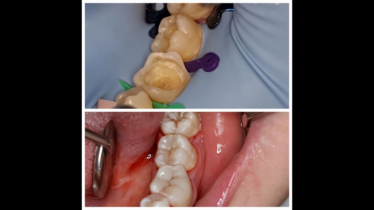 بناء التشريح للكومبوزيت للسطح الطاحن لرحى سفلية anatomy by composite for lower molar