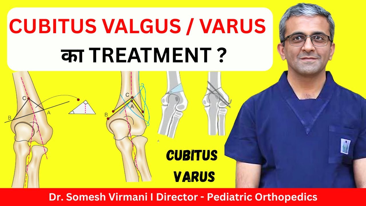 Cubitus Varus: कब ज़रूरी होती है Surgery? | Cubitus Valgus Difference | Dr. Somesh Virmani
