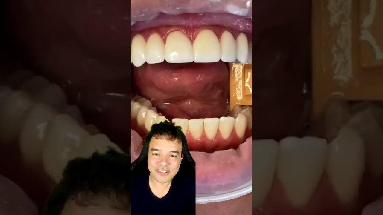 ISSO SIM S&Atilde;O FACETAS DE PORCELANA BEM FEITAS #shorts