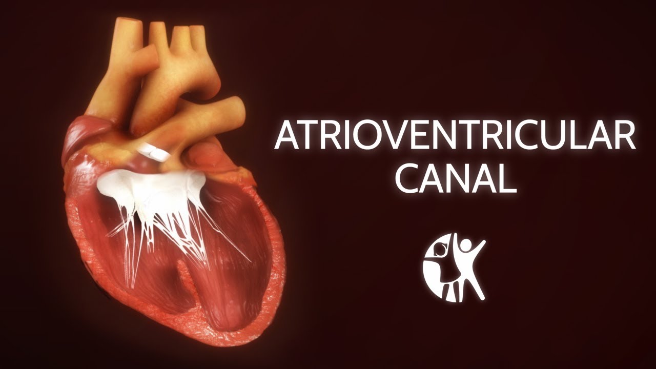 Atrioventricular Septal Defect - AV Canal