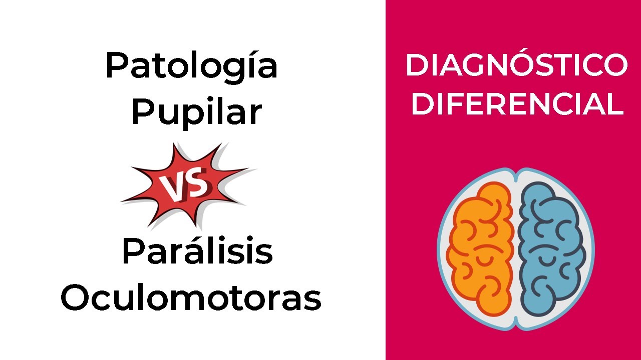 Diagnóstico Diferencial. Patología Pupilar y Parálisis Oculomotoras