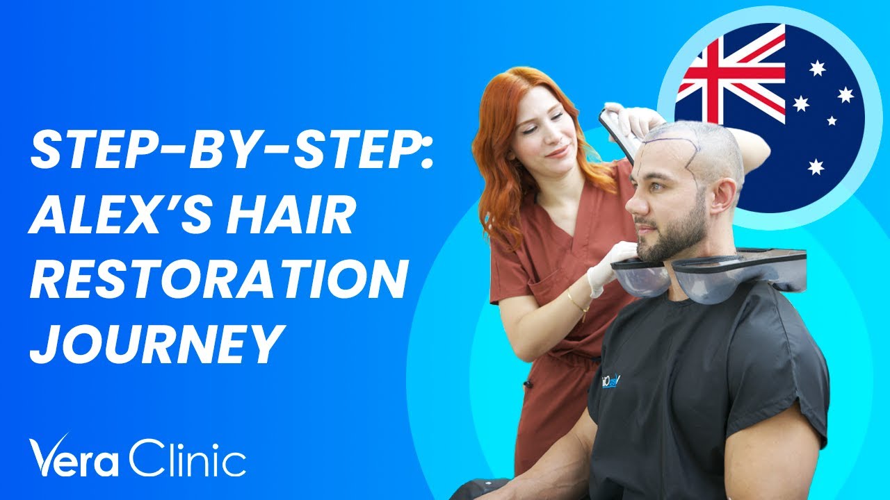 Step By Step: Alex's Hair Restoration Journey✈️✨ #HairTransplant