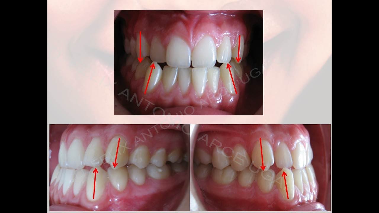 Tratamiento Maloclusion CLASE III ( CAMUFLAJE CLASE III)